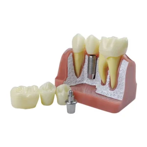 Decorative Analysis Model Crown Bridge Demonstration Teaching Model, Removable Training Study, 4 Times